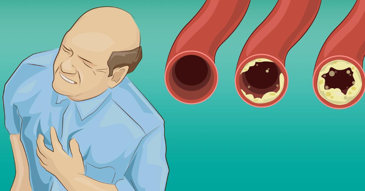 Prevenzione naturale contro lâinfarto: mangiate questi cibi.