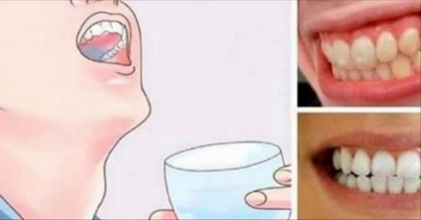 Sciacqua la bocca con questa miscela per 30 secondi. Tartaro e placca scompariranno in poco tempo!
