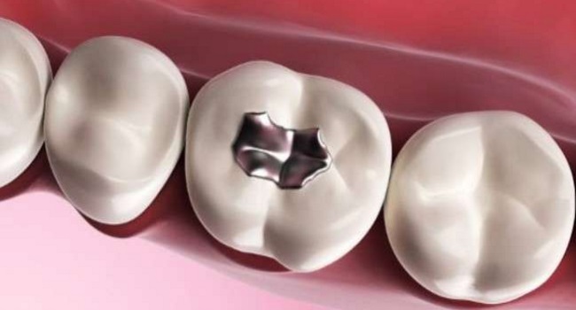 Addio dentista per le otturazioni, adesso i denti si riparano da soli grazie a questa scoperta.