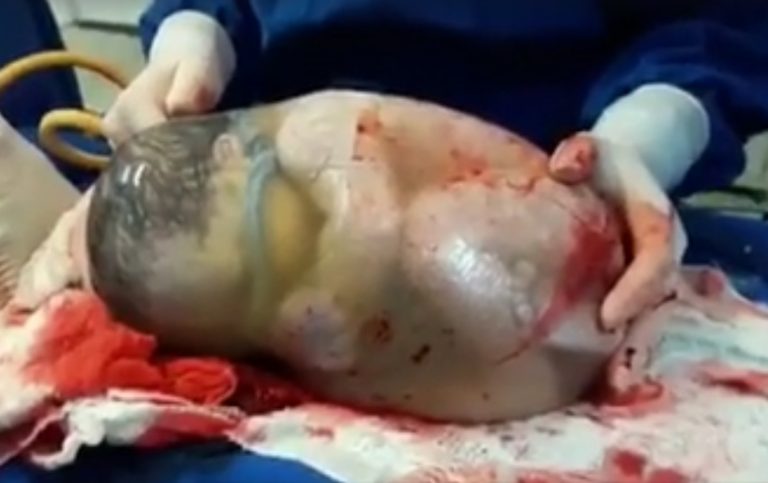 L'affascinante video di un bambino che nasce nel sacco e si muove:
