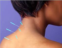 How Acupuncture Relieves Back, Joint, and Muscle Pain in Morristown